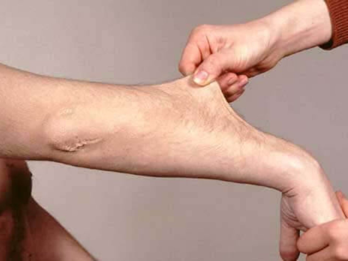 Syndrome d'Ehlers-Danlos